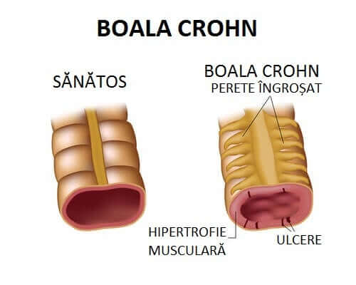 Boala Crohn exemplu